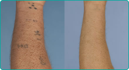 Tattoo removal - before (left) after (right)